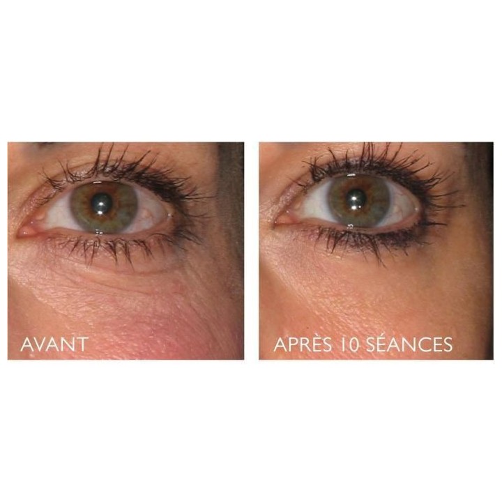 Réductions des rides et raffermissement du visage - SILK'N Facetite E